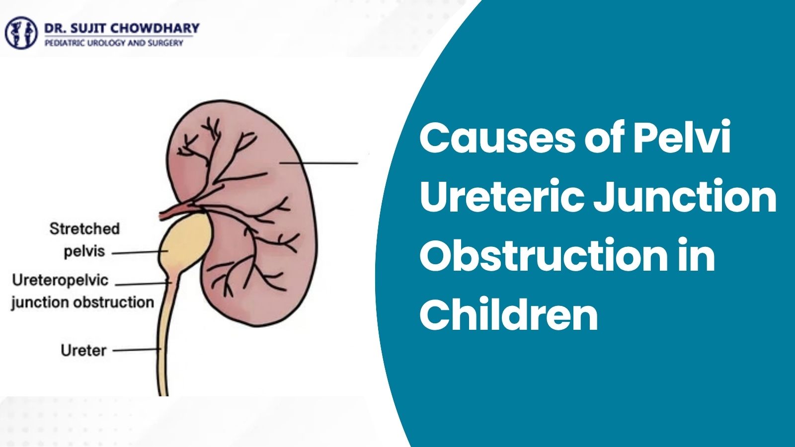 Causes of Pelvi Ureteric Junction Obstruction in Children - Stretched Renal Pelvis Diagram